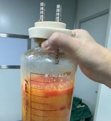 攸县水动力吸脂手术要做多久？